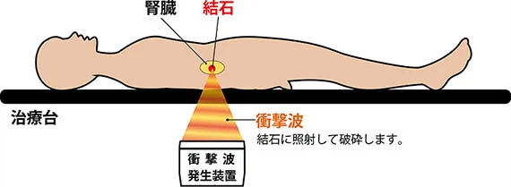 身体への侵襲が小さく内視鏡手術と比較し合併症が少ない