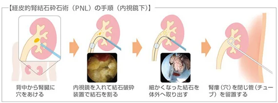 尿道から 細い内視鏡を入れて尿管または腎臓の結石をレーザで砕石します。