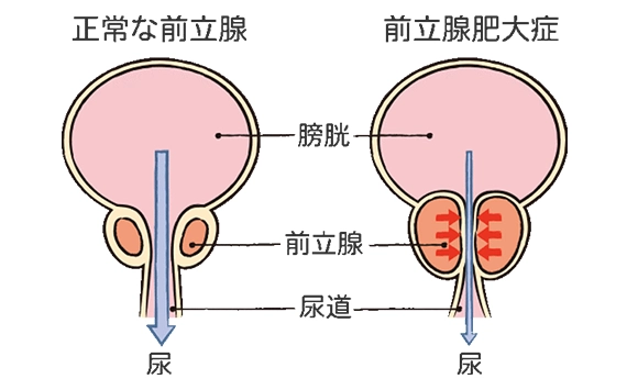 尿道から 細い内視鏡を入れて尿管または腎臓の結石をレーザで砕石します。