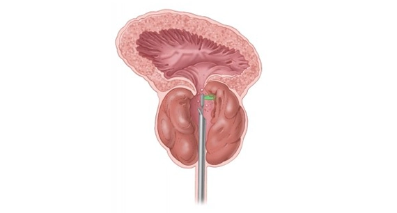 肥大した前立腺組織をグリーンライトレーザーで蒸散させる