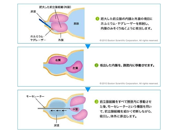 HoLEPの手術術式概要